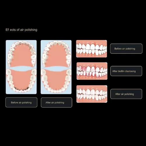 Máy thổi cát vệ sinh răng Woodpecker AP H
