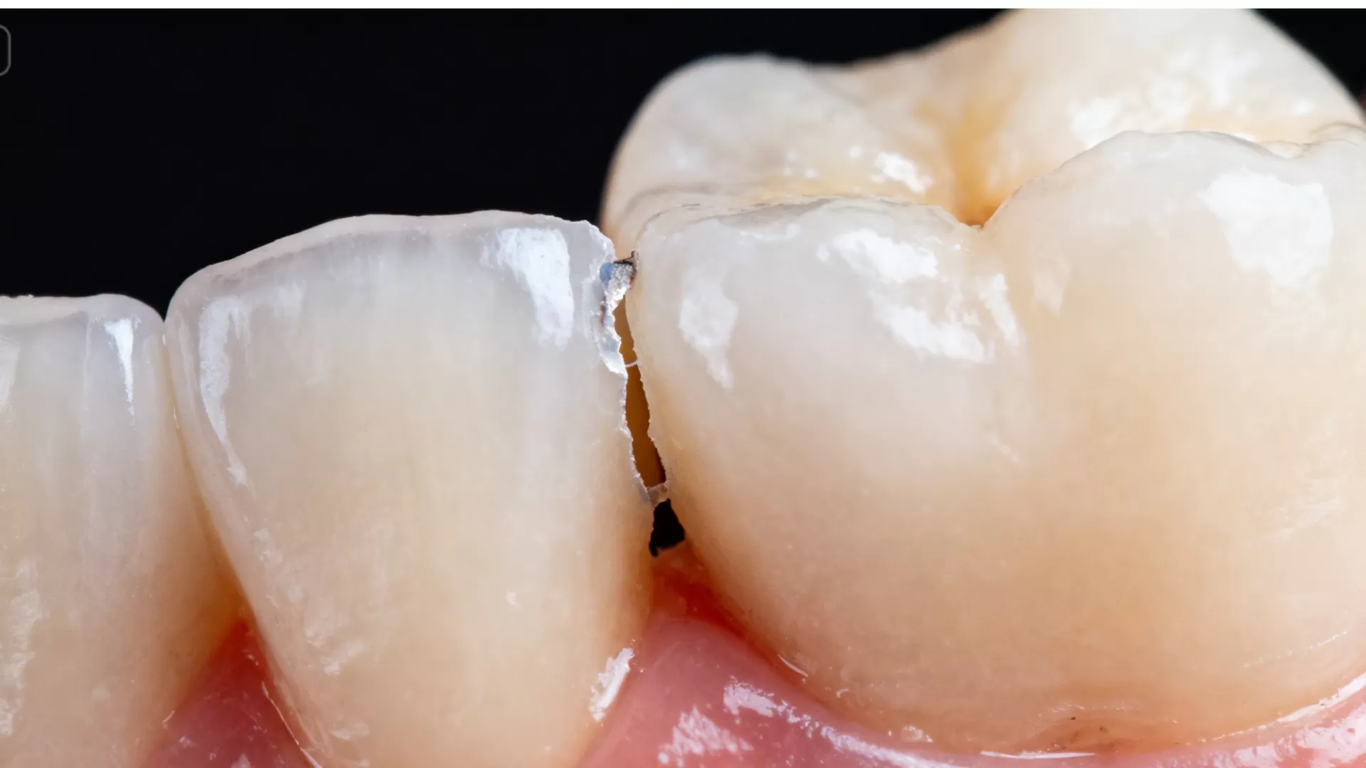 Vì sao miếng trám dễ bong? Có phải do đèn trám răng?